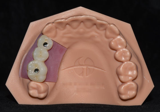 Implant Porcelain Fused To Zirconia Implant Crown Bridge Highly Aesthetic