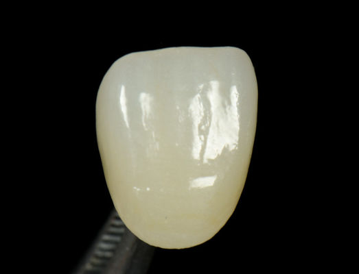 Buy Customizable Emax Press Crown Fast And High Esthetics Dental Inlay Onlay online manufacture