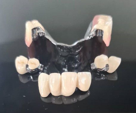 Buy Metal Framework Precision Attachment Overdenture Removable Tooth Denture online manufacture