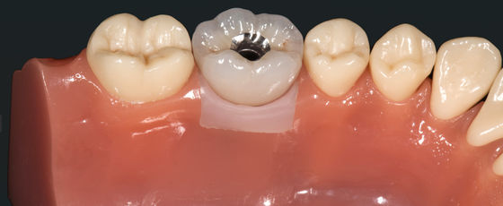 Buy Highly Aesthetic Precious Metal Crown Implant Crown Bridge Metal Alloys online manufacture