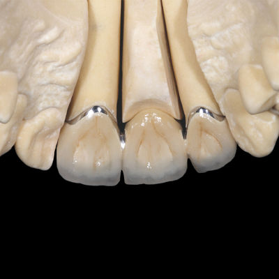 Buy Non Precious PFM Crown Implant Porcelain Fused To Metal Crown online manufacture