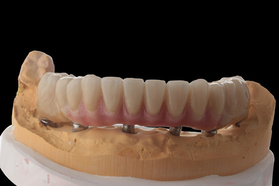 Buy Customize Hybrid Dental Implants Hybrid Denture With Titanium Bar online manufacture