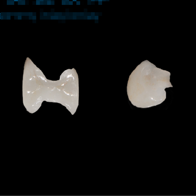 Buy Lithium Disilicate Milling Crown Onlay Veneer High Accuracy Dental Inlay Onlay online manufacture