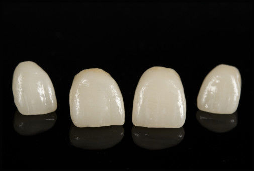 CAD/CAM Porcelain Fused To Zirconia Bridge For Natural Looking Restoration