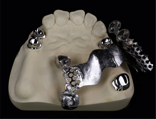 Removable Artificial Teeth Telescope With Composite And Metal Framework Denture Finish
