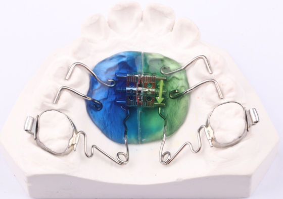 FDA Pendulum Appliance Orthodontics Pendulum Ortho Appliance Customizable