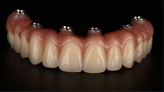 All On X Implant Supported Dentures Titanium Bridge Dental CE FDA Approval