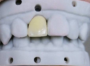 High Esthetics Composite Crown Onlay Veneer Customizable Size