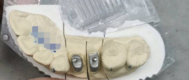 Metallic / Natural Ti Base Crown Post Core Titanium Crowns For Teeth