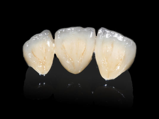 Implant Dental PFM Bridge Non Precious CAD CAM PFM Crown