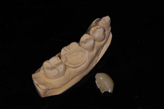 Dental Composite Onlay Veneer High Esthetics Composite Veneer