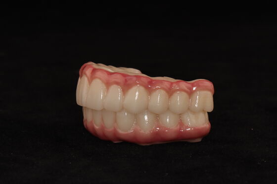 All On X-Zirconia Bridge