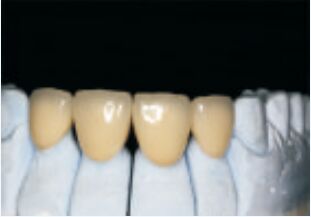 White High Noble Precious Alloy Crown And Bridge Accurate And Custom