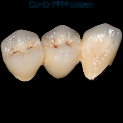 Good price Noble Precious Alloy Crown And Bridge Yellow Provisional Crown online